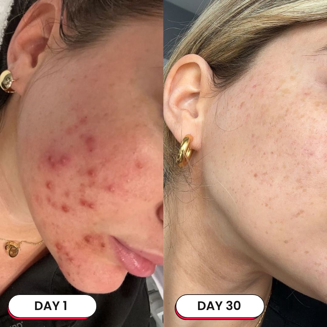 Acne Marks Corrector